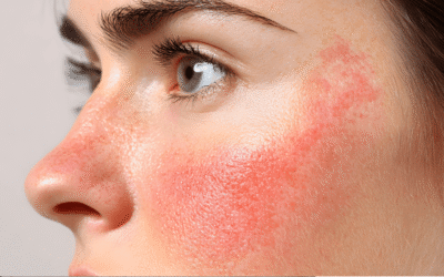 Rosazea verstehen: Warum Fruchtsäure und Microneedling mehr schaden als helfen