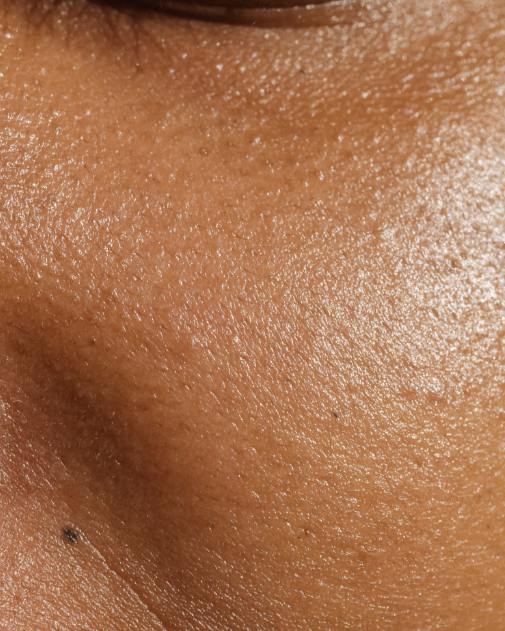 Microneedling Behandlung in Münster zur Verfeinerung großer Poren