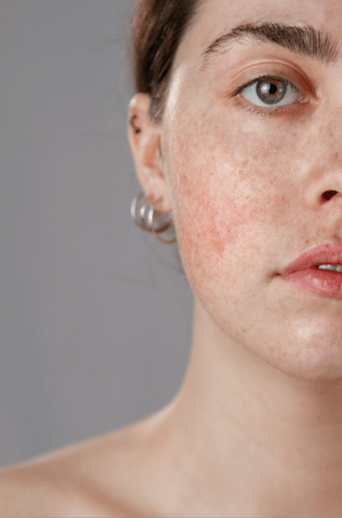 Microneedling Behandlung in Münster zur Verfeinerung großer Poren