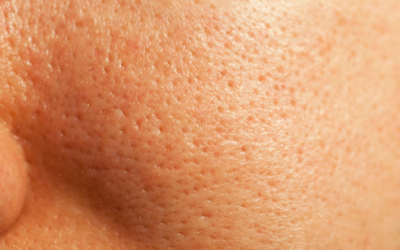 Große Poren verstehen und sichtbar verfeinern