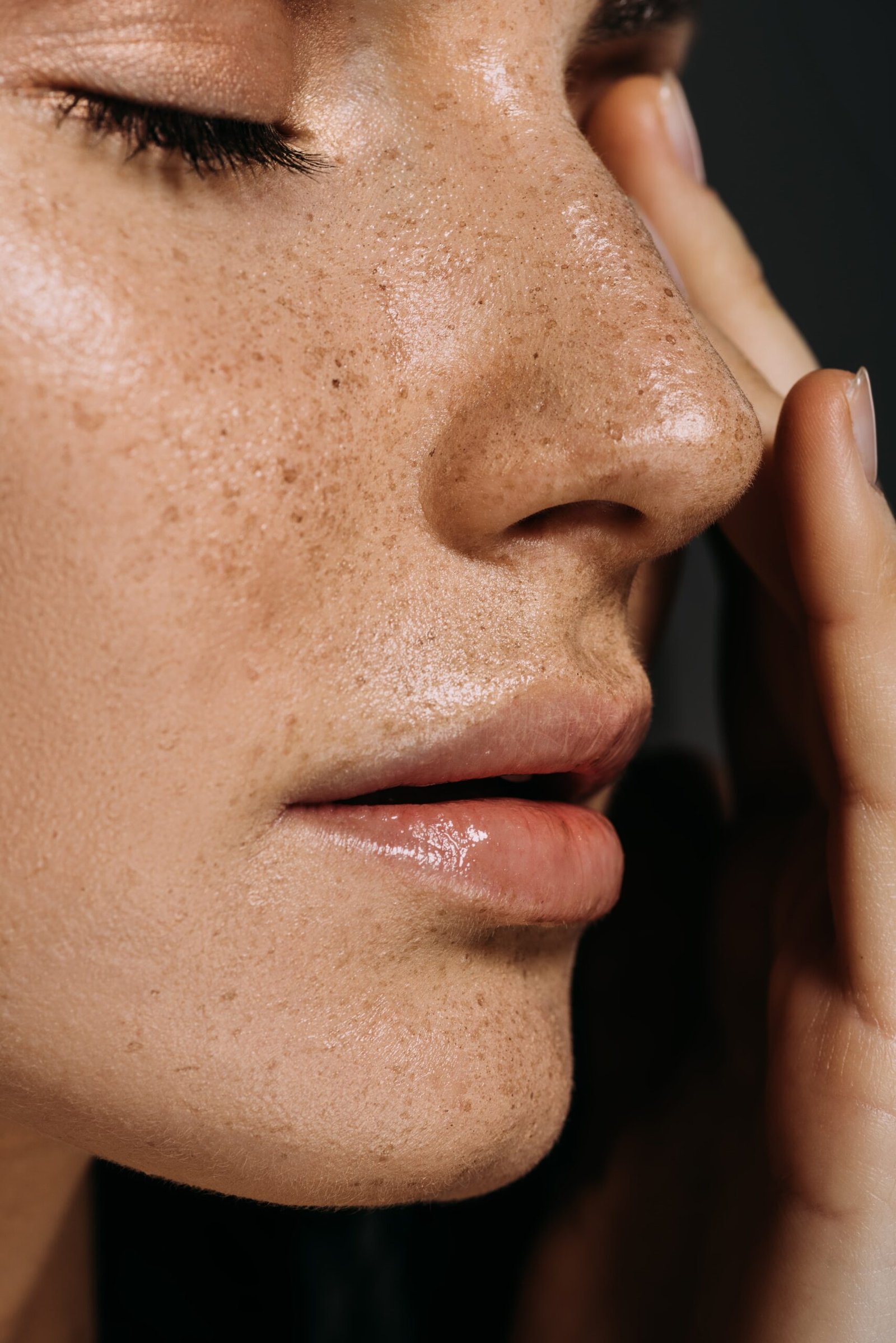 Microneedling Behandlung in Münster zur Verfeinerung großer Poren
