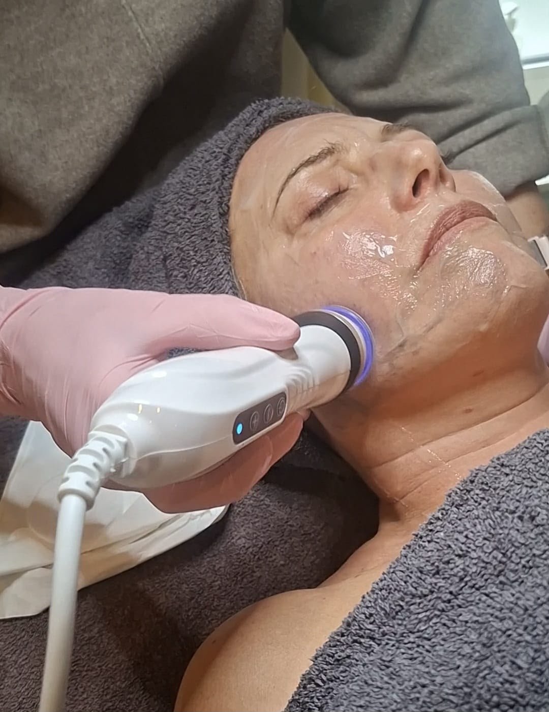 glatte starffe Haut durch Microneedling